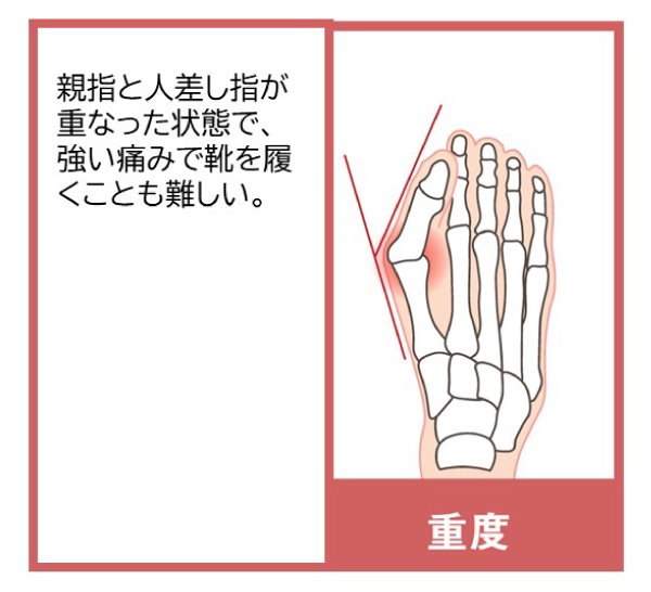 重度の外反母趾:親指と人差し指が重なった状態で、強い痛みで靴を履くことも難しい